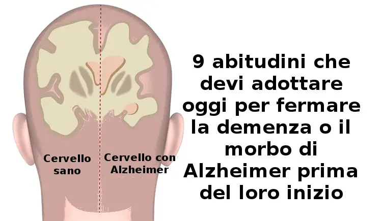 9 abitudini che devi adottare oggi per fermare la demenza o il morbo di Alzheimer prima del loro inizio