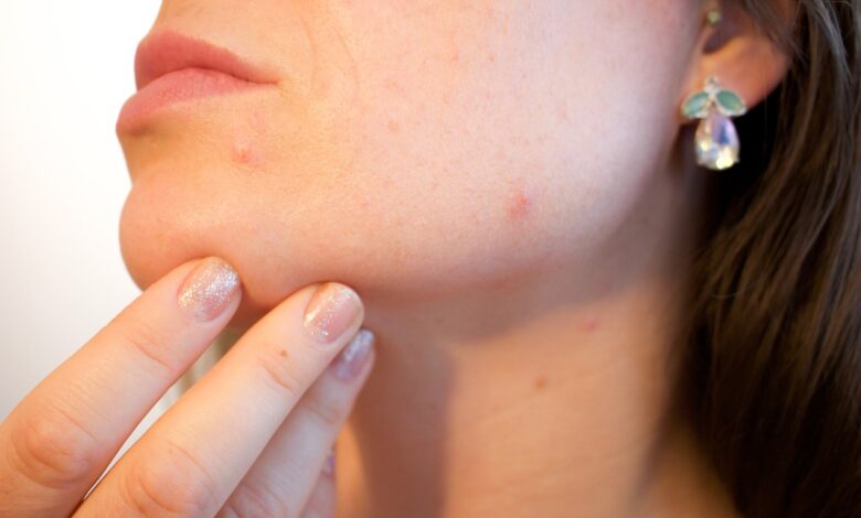 acne, pores, skin