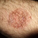 Hundreds of bed bugs having fed in one place